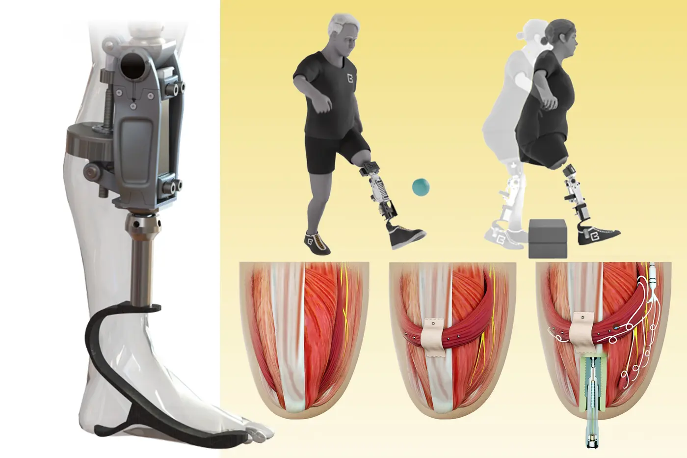 a bionic knee integrated into tissue can restore natural movement