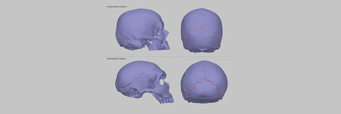 interbreeding with neanderthals may be responsible for brain condition