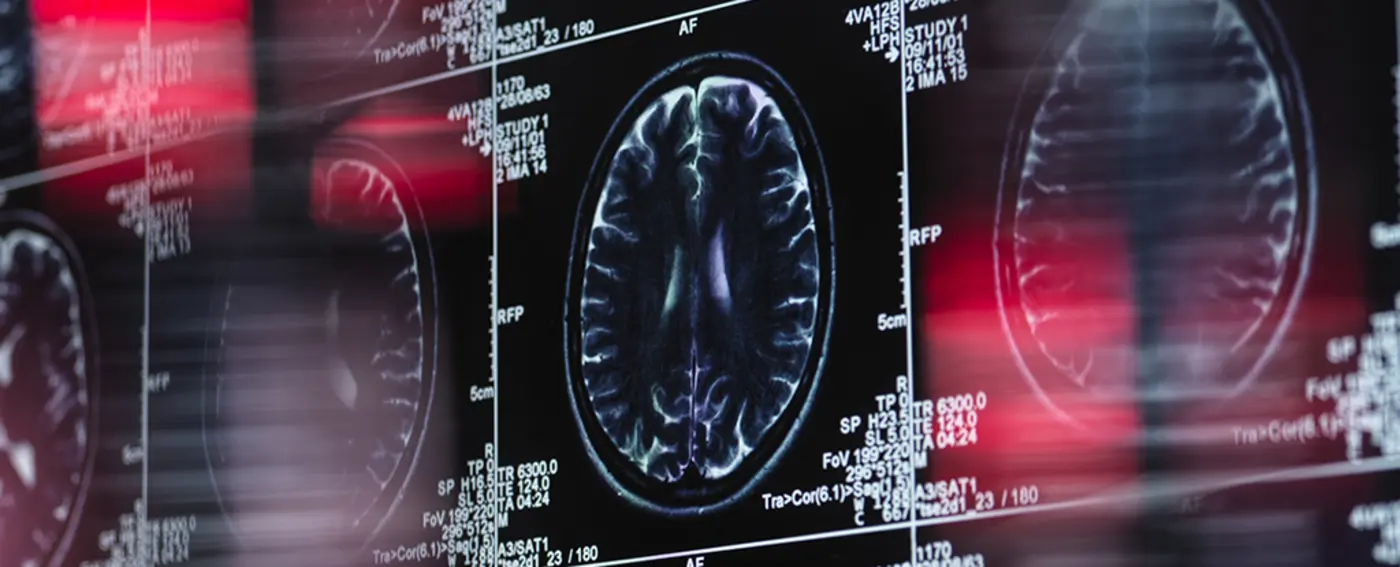 dementia linked with treatment for chronic lower back pain