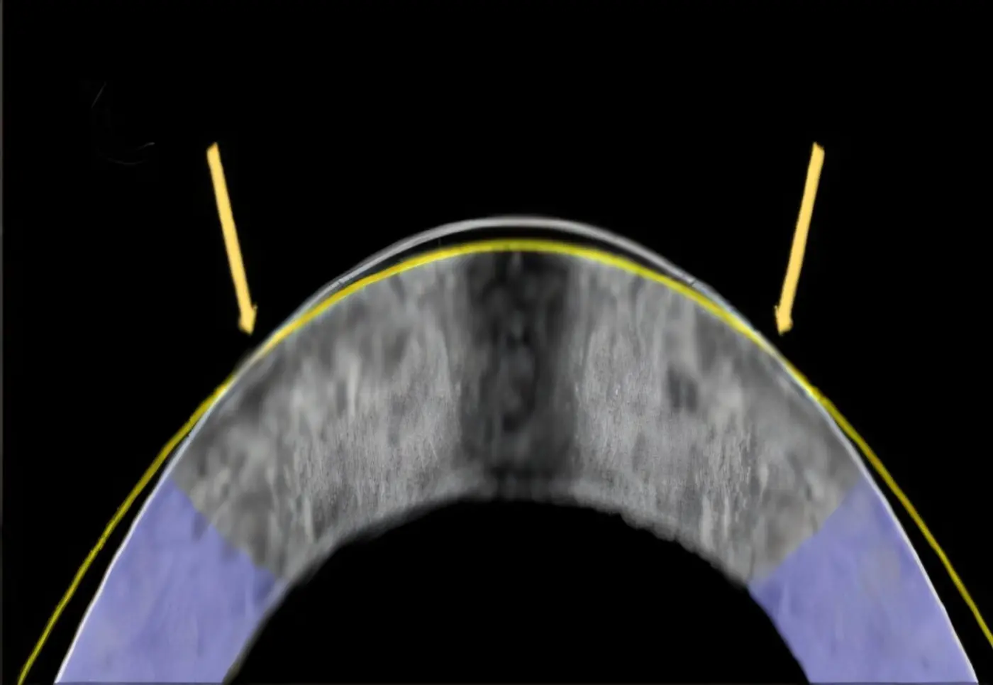 an alternative to lasik eye surgery electromechanical remodelling
