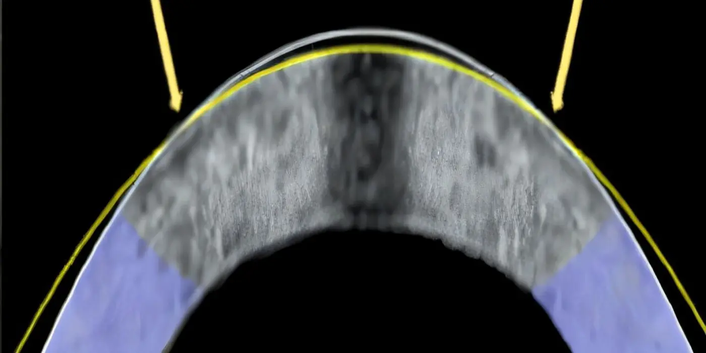 electromechanical reshaping offers safer eye surgery