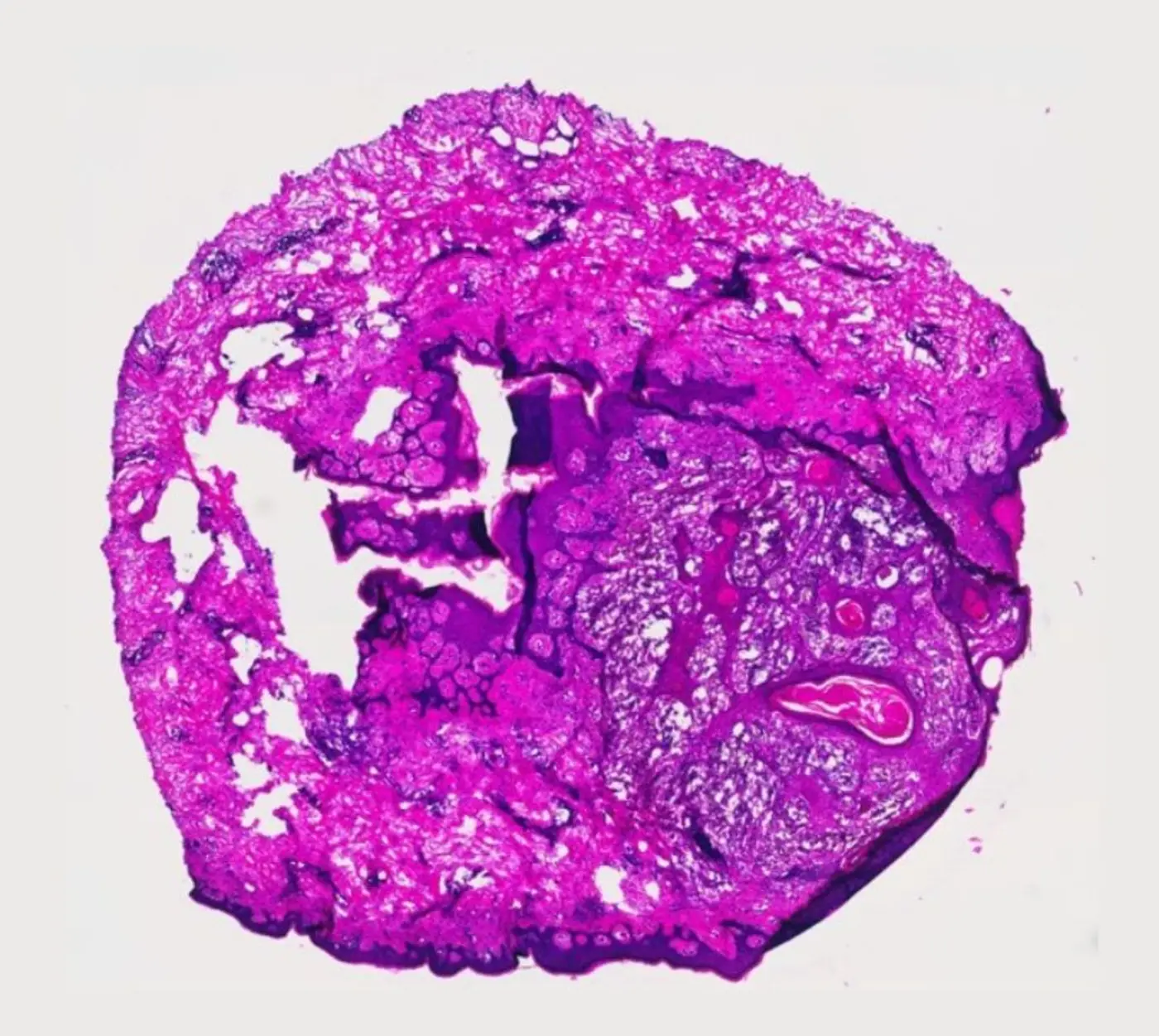 immunotherapy drug eliminates aggressive cancers in clinical trial
