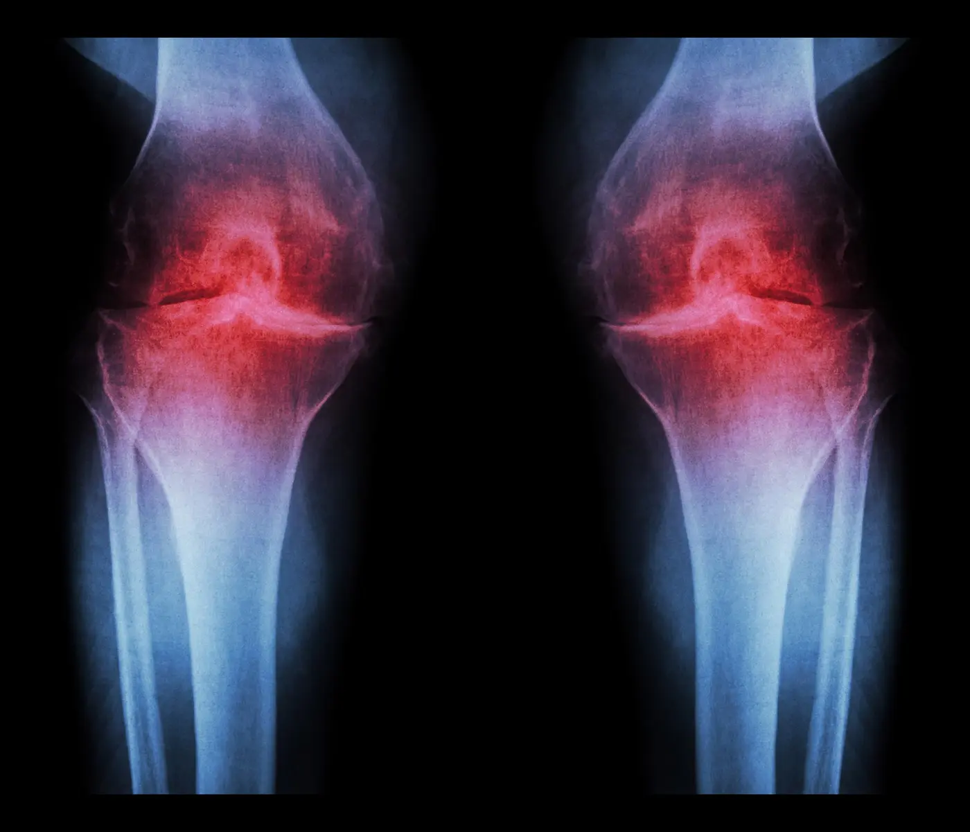 antiaging injection regrows knee cartilage and prevents arthritis