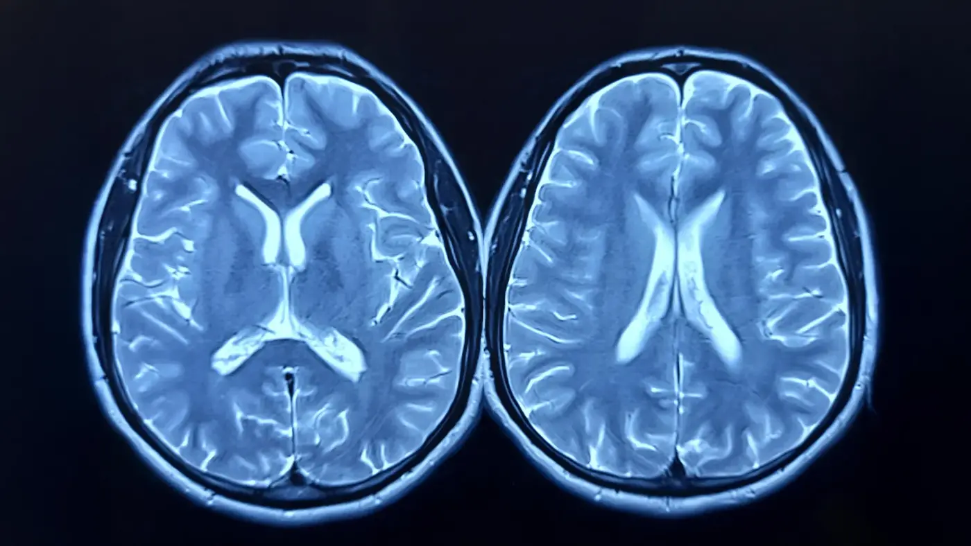 mri scans show exercise can make the brain look younger