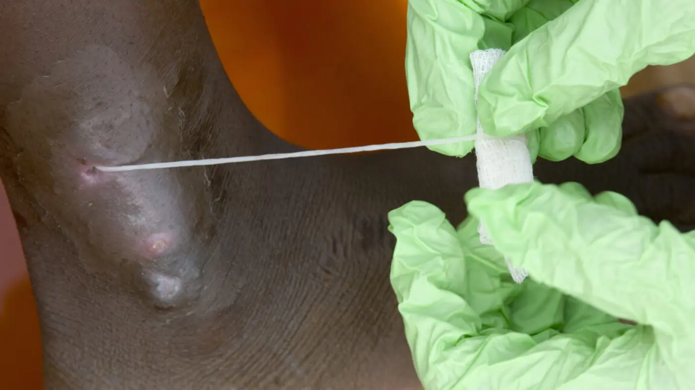 guinea worm on track to be 2nd eradicated human disease only 10 cases in 2025