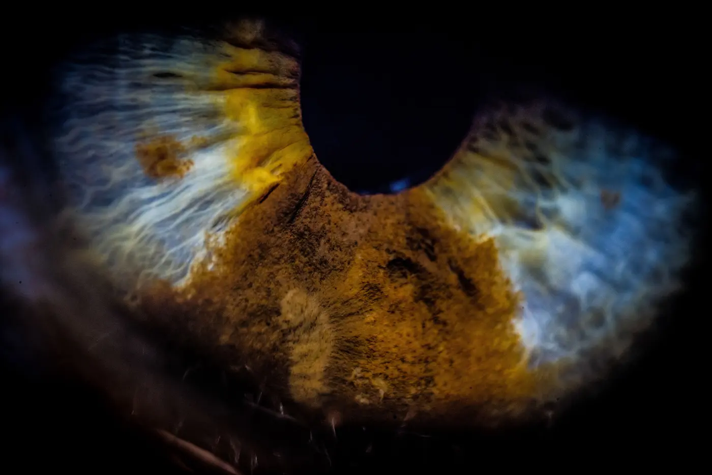 common bacteria discovered in the eye linked to cognitive decline