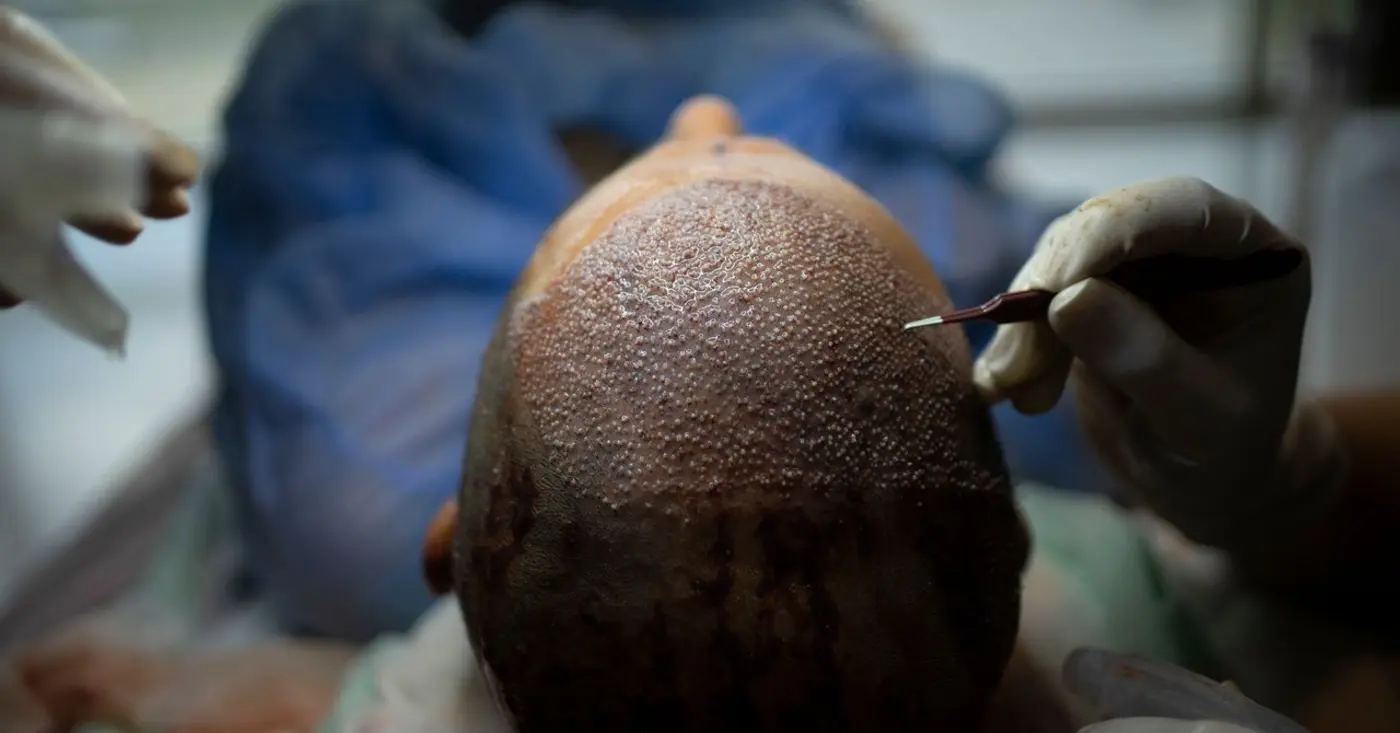 turkey hacked the hair transplant industry