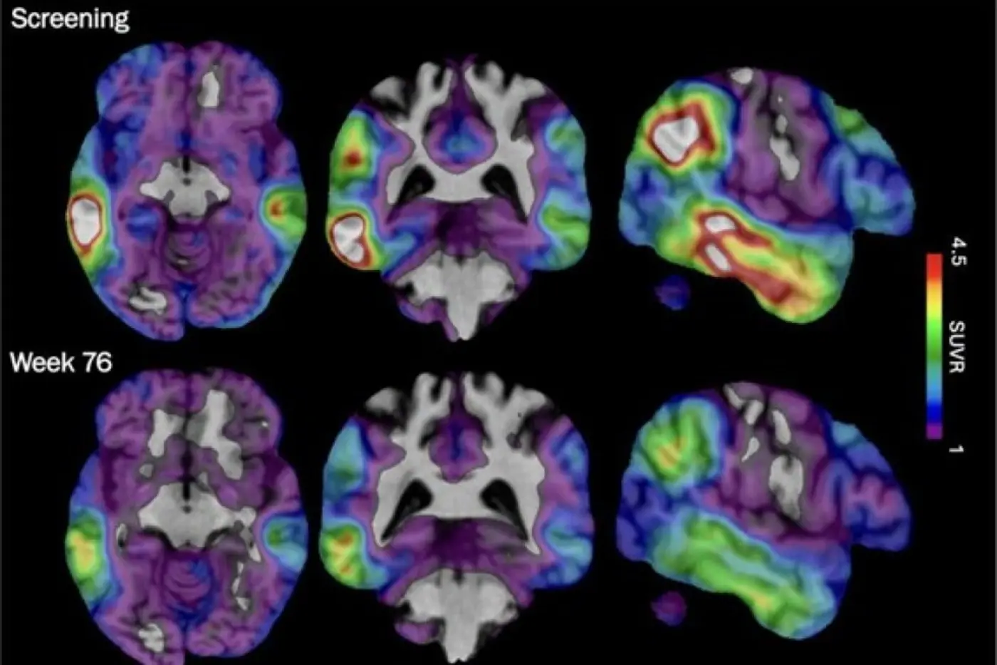 experimental alzheimerx27s drug shows promise targeting a different brain protein