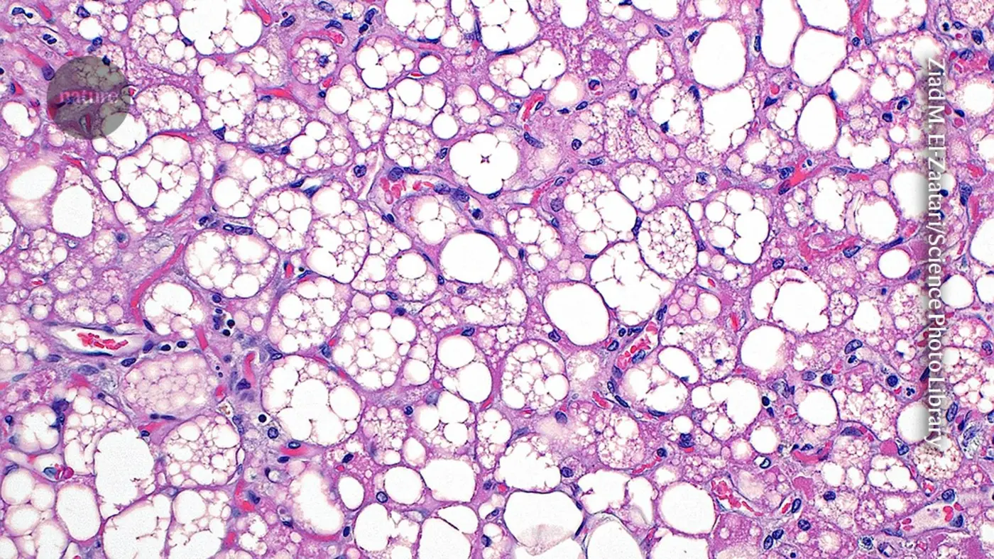 overlooked brown fat in our bodies linked to wide range of health benefits