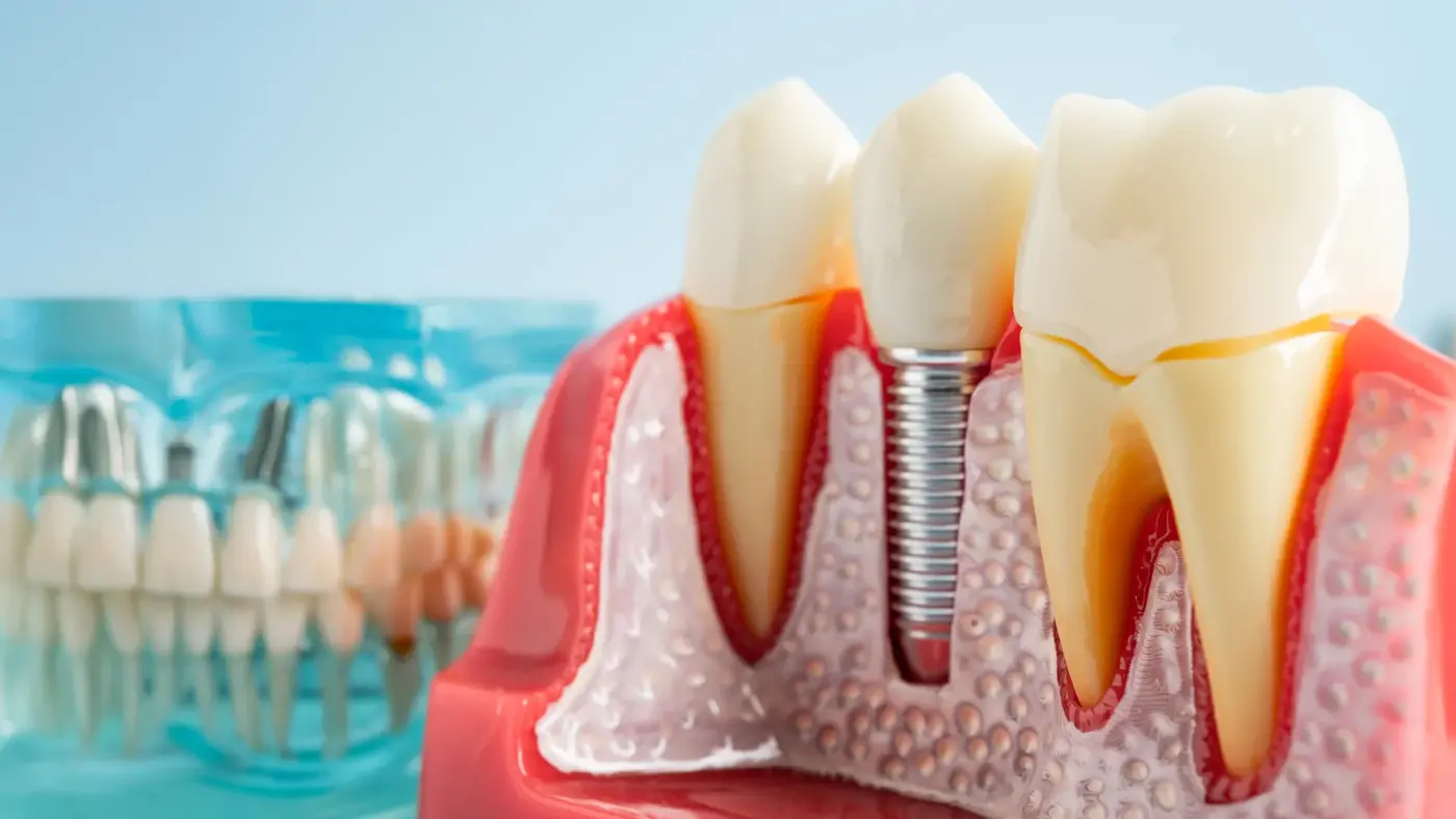 dental implants can hijack your immune system scientists discover